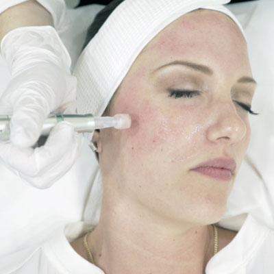 Micro Needling